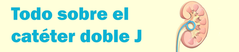Todo sobre el catéter doble J